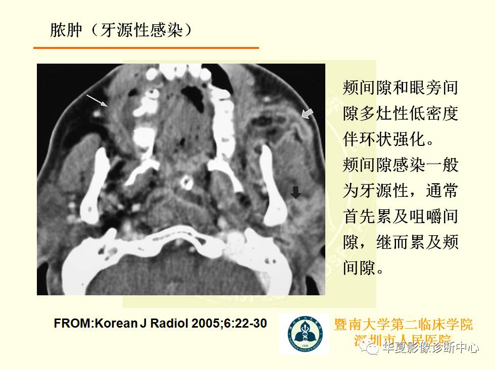 颊间隙影像学解剖与病变的诊断