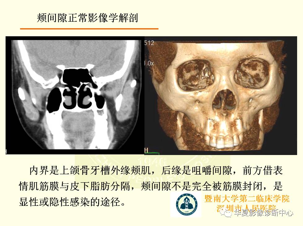 颊间隙影像学解剖与病变的诊断