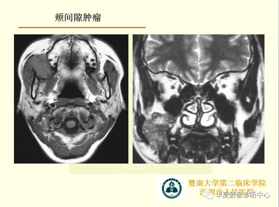 颊间隙影像学解剖与病变的诊断