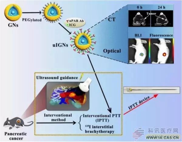 分子影像技术应用于胰腺癌的介入光热治疗取得临床科研成果