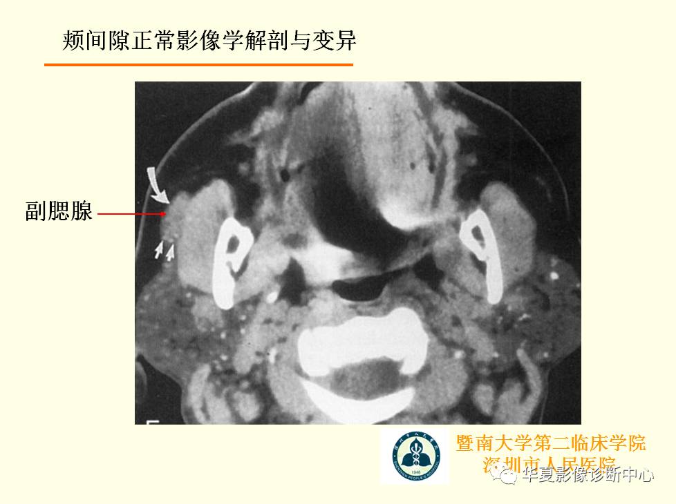 颊间隙影像学解剖与病变的诊断