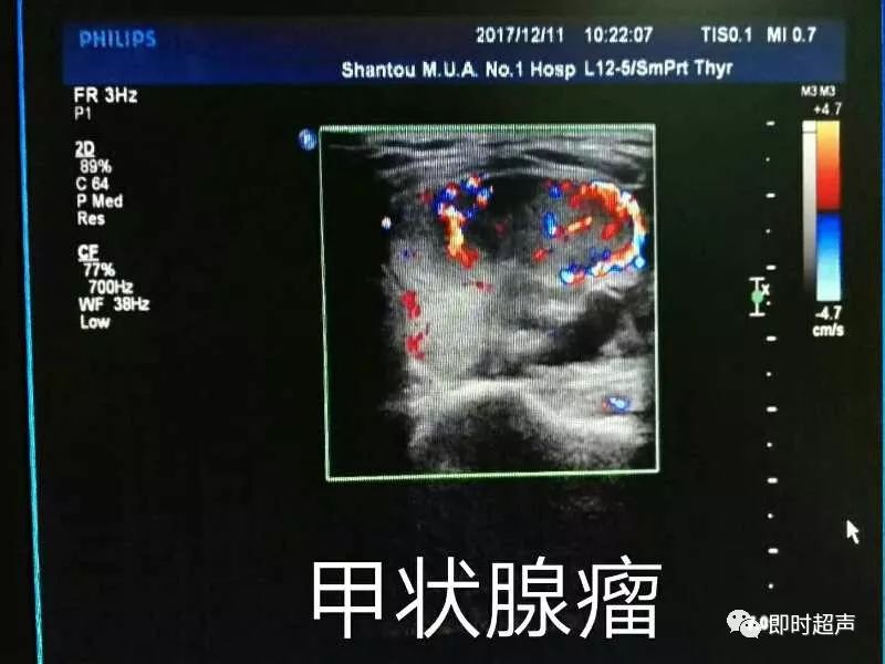 简单易懂的甲状腺超声手绘