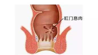 体检发现肛门息肉,不痛不痒需要治疗吗?