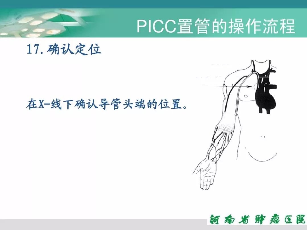 picc置管详细流程及维护步骤超实用