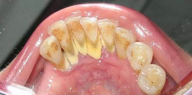 怎么区分牙垢和牙结石?只需做这一点