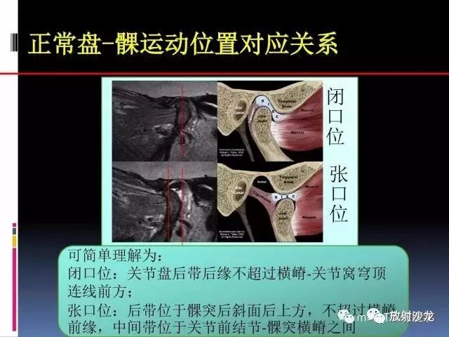 江西中医药大学附属医院张静坤—《颞下颌关节内紊乱