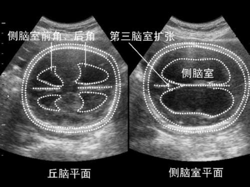 准妈妈注意:孕期这9种胎儿疾病b超是查不出来的!