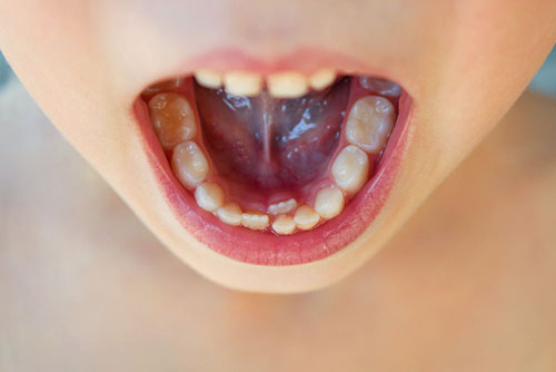 孩子换牙需要补钙吗 孩子换牙时期注意事项|育儿大师