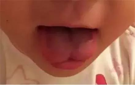 快看看你家宝宝是这种舌头吗?如果是,要小心了!
