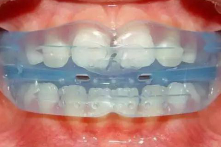 mrc肌功能矫治正畸,为牙齿健康成长保驾护航