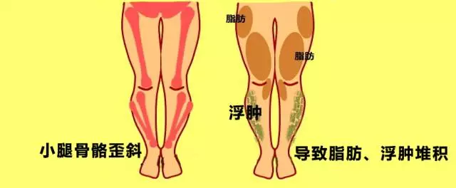 但你的腿还得保持平衡,所以大腿外侧肌肉越来越发达,内侧肌肉越来