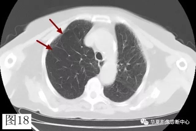 影像基础再看肺气肿收获不一样