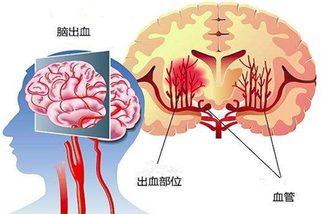 高血压脑出血怎么治疗呢?