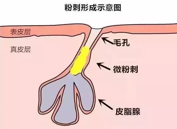 这些挤不出来的东西叫脂栓,是脱落的角质和皮脂混合