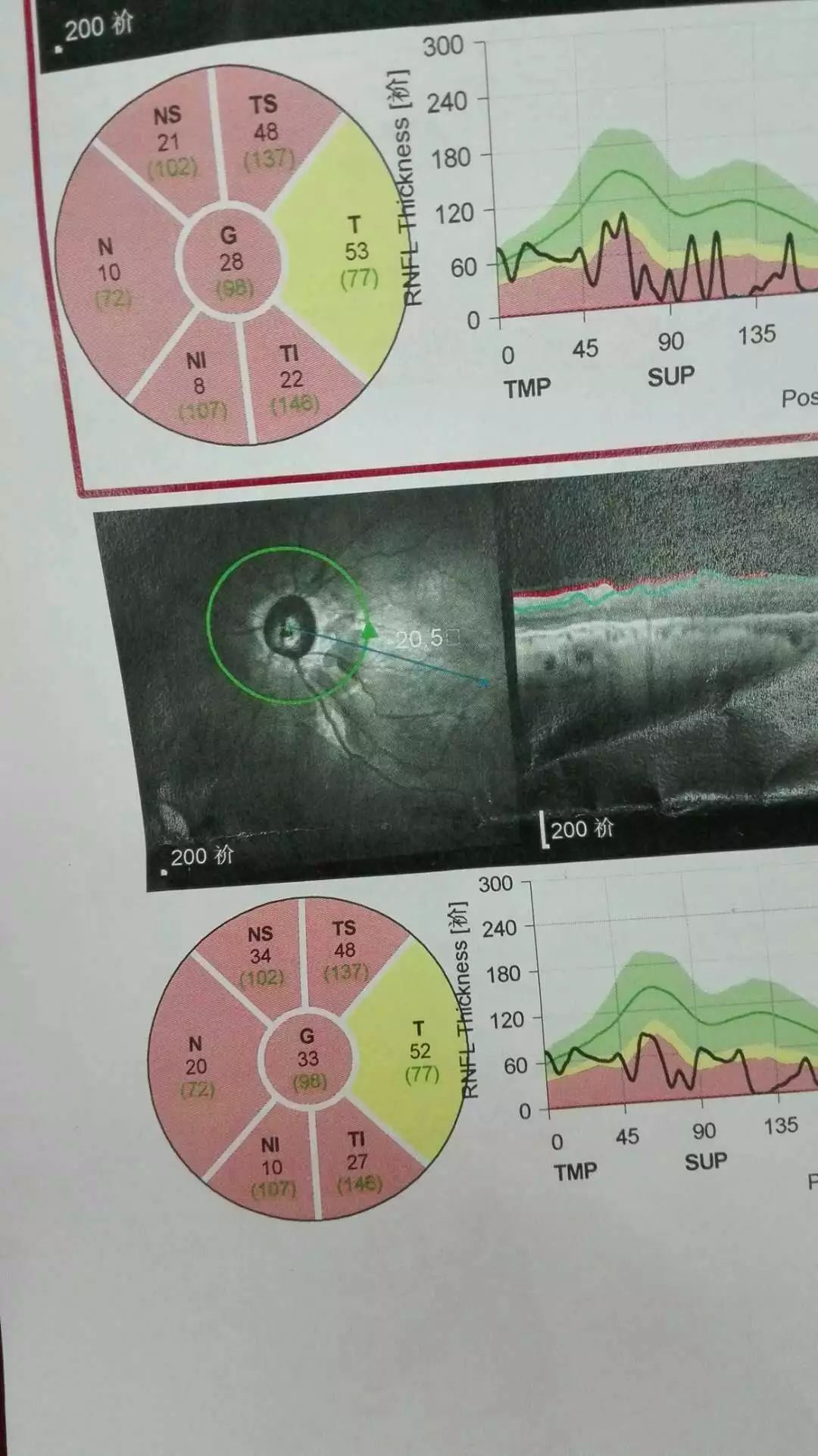 眼病 针灸治疗视神经萎缩,视程从5cm提升到1m