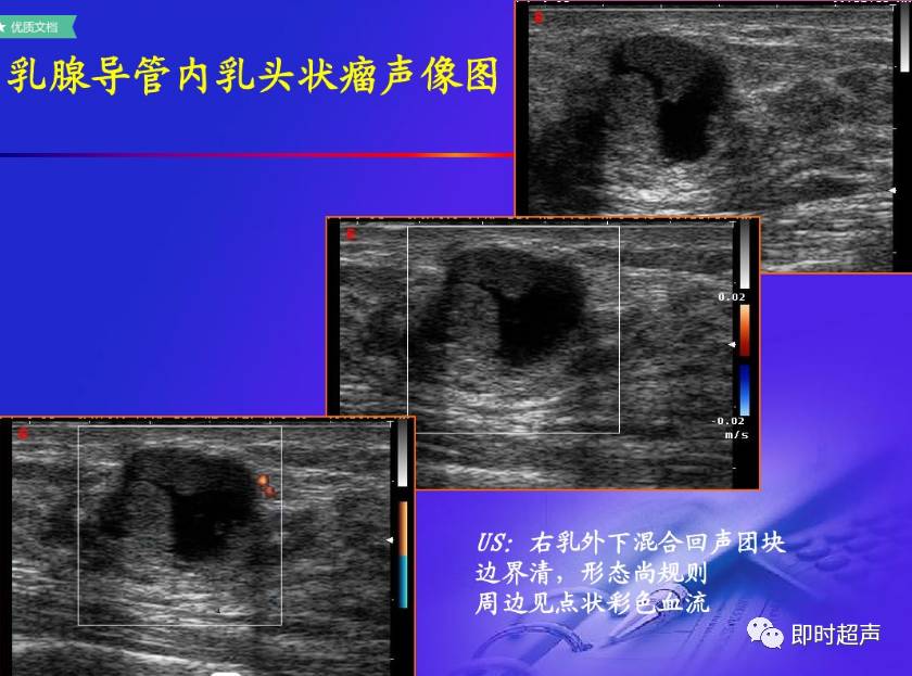 乳腺疾病超声诊断