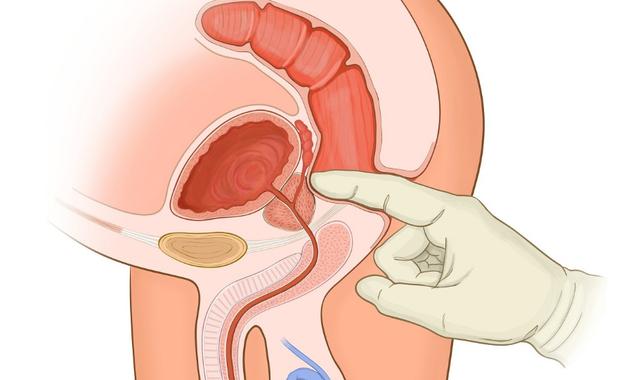 前列腺钙化灶是什么意思