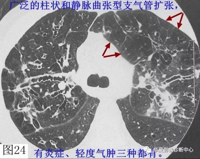 间隔旁型肺气肿累及肺小叶远侧部分,故多位于胸膜下(黑箭).