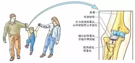 母婴 正文  之所以发生桡骨头半脱位,是因为4岁以下小儿的桡骨头尚未