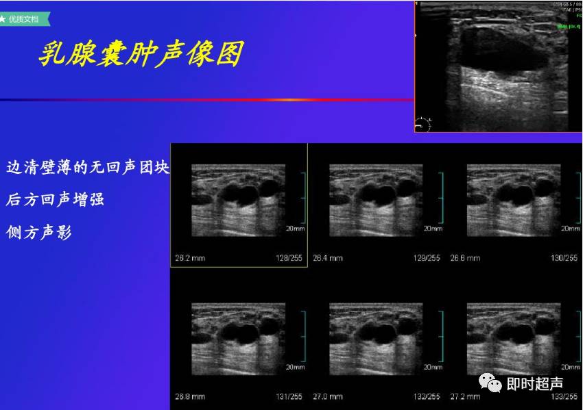 乳腺疾病超声诊断