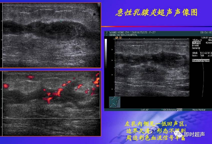 乳腺疾病超声诊断