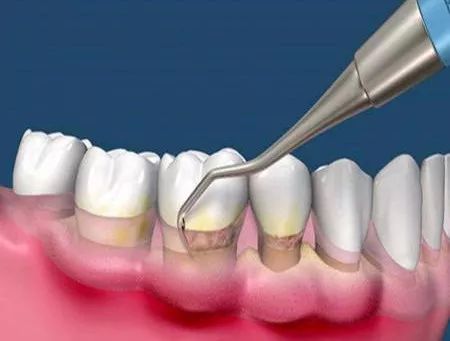 牙龈下有牙结石的,就要进行牙周刮治即龈下洁牙了.
