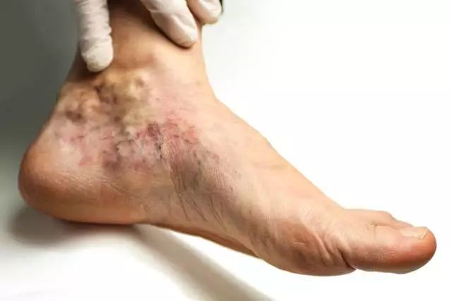 热水泡脚还可以导致毛细血管破裂,形成皮肤上的出血点.
