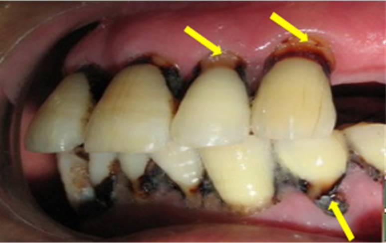 龋坏严重者,致使牙齿断裂,成为残冠残根,影响咀嚼功能,加重胃肠负担.