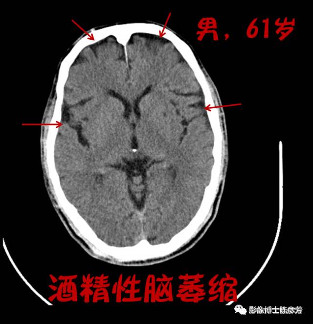 喝酒喝出脑萎缩不是危言耸听