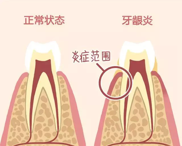 矫正牙齿同时也要牙龈健康,你必须知道这些!