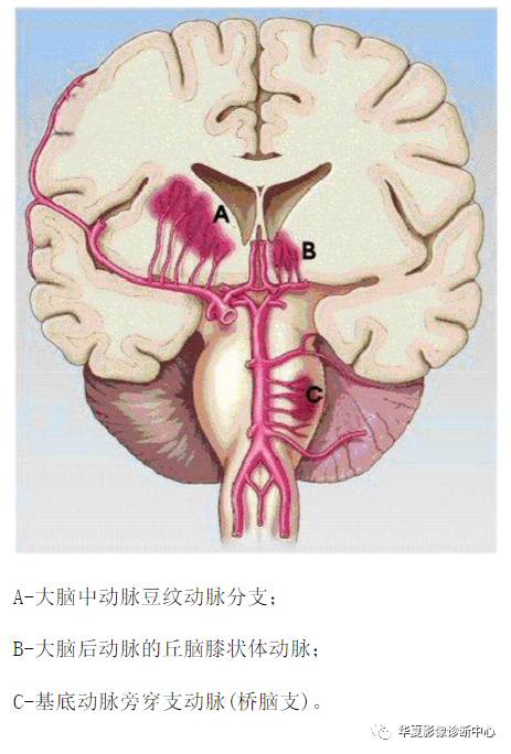 由于磁共振对水成像的敏感性,腔隙灶,脱髓鞘和血管周围间隙在磁共振的