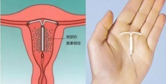 荆州东方妇科医院 ▏取环再小也是手术,不注意这些可不行!