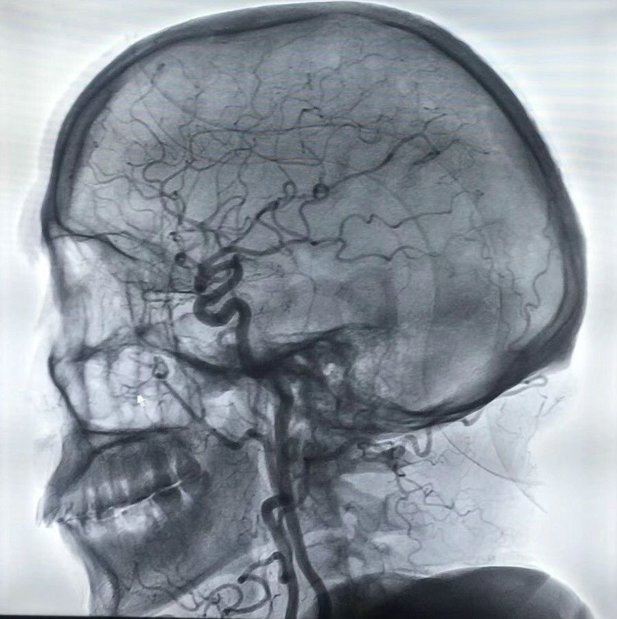 于次日上午在局麻下行脑血管造影术,分别行主动脉弓,双侧颈总动脉