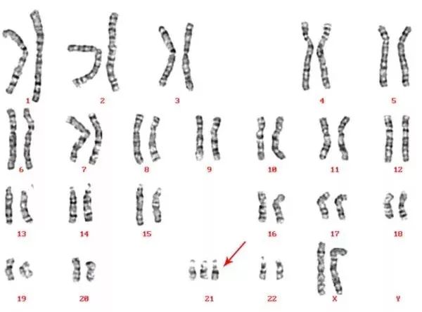 爱德华兹综合症(18-三体综合征),特纳氏综合征等等