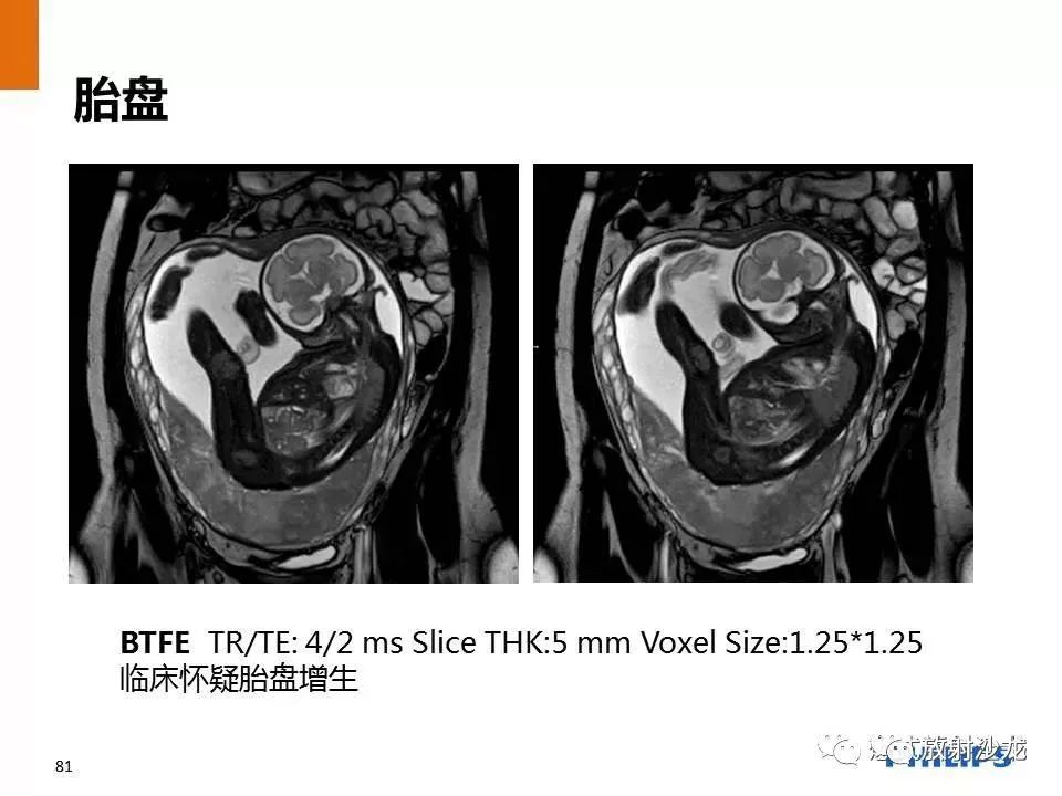 磁共振产前检查胎儿胎盘大全