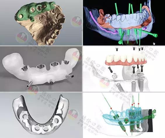 恢复快,安全系数高, 全部仰仗这项核心技术—— 全程3d导板数字化种植