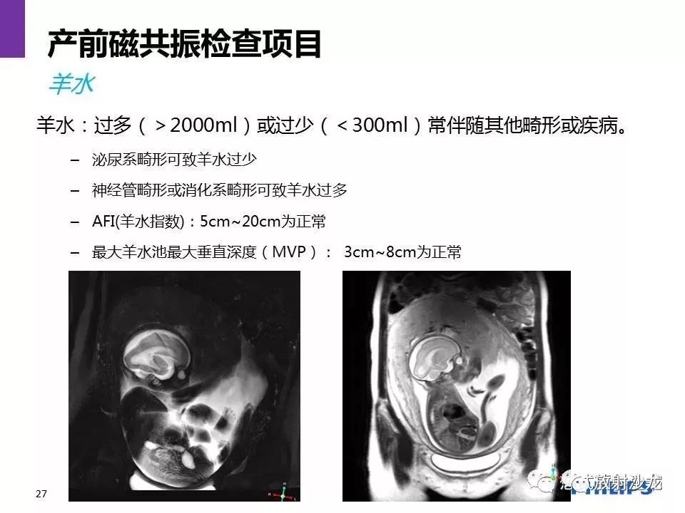 磁共振产前检查胎儿胎盘大全