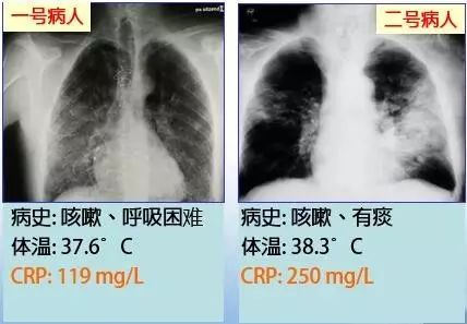 肺炎诊断治疗,没那么简单!