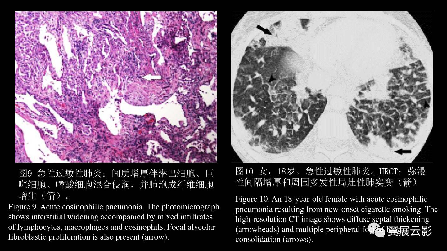 急性呼吸窘迫综合征ards的影像学表现