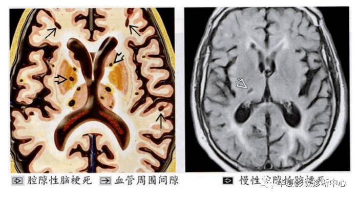 由于磁共振对水成像的敏感性,腔隙灶,脱髓鞘和血管周围间隙在磁共振的