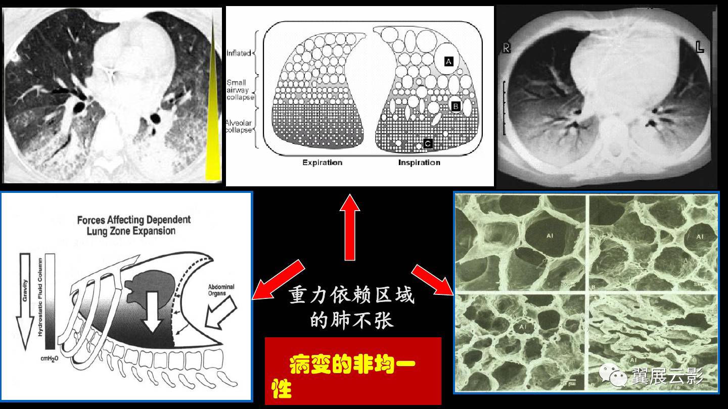 急性呼吸窘迫综合征ards的影像学表现