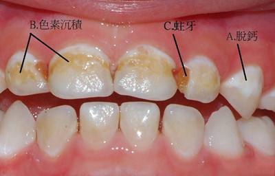 (除了蛀牙,引起口臭的原因很多,小编在这里就不加以赘述了) 蛀牙如何