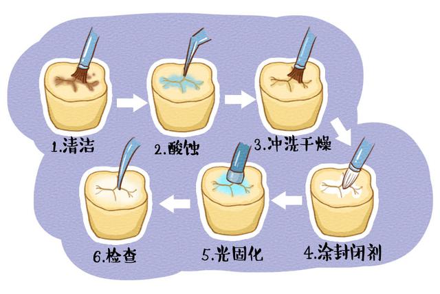 和宝宝们害怕的补牙不同,窝沟封闭处理过程很简单,四颗牙全部做完只要