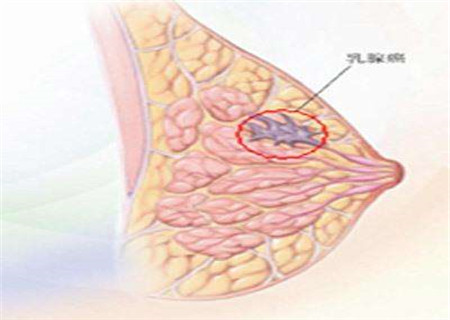 乳头内陷糜烂怎么治疗 这些方法来帮你