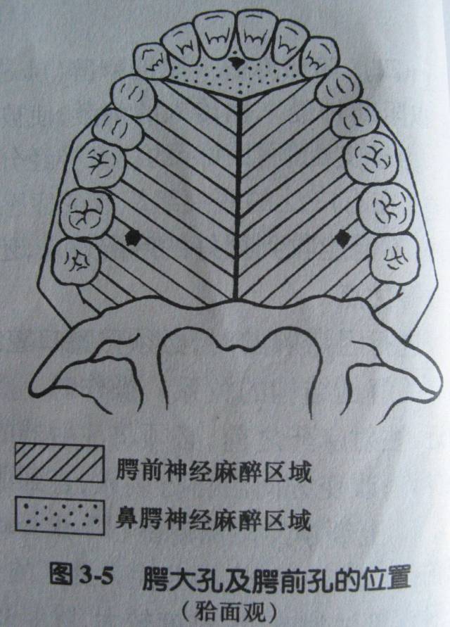 进针点:翼下颌皱襞中点外侧3-4毫米或颊脂垫尖处.针尖退至黏膜下.