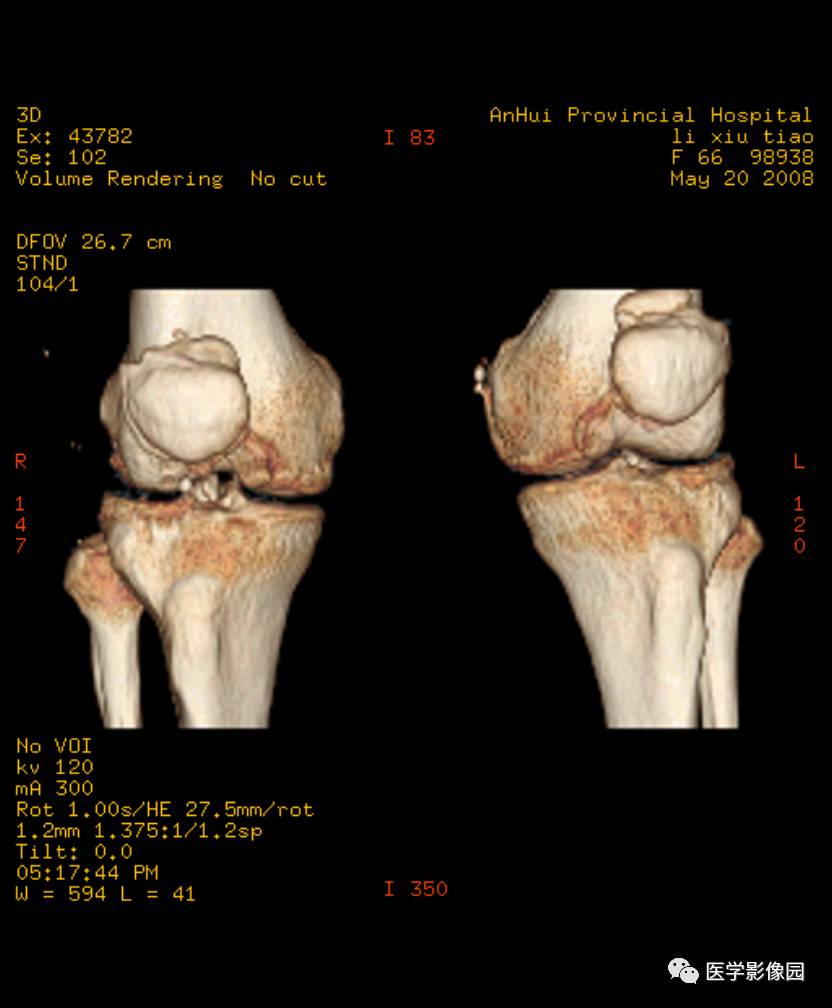两侧胫骨髁间隆突骨质增生变尖, 以右侧为明显(↑), 胫骨平台关节面见