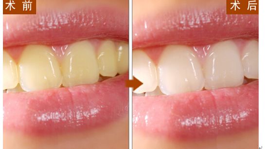 瓷贴面是直接粘接在牙齿的釉质层,就相当于把透明胶黏贴在玻璃上.