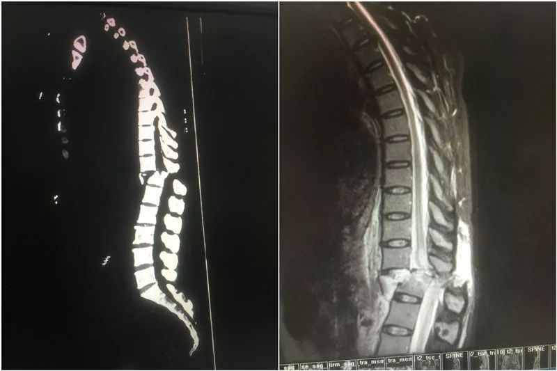 胸12椎体爆裂骨折