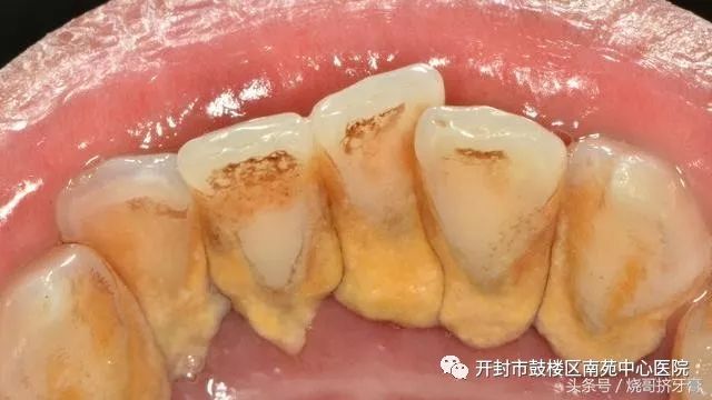 牙齿内侧,有黄色的污垢,需要去医院处理吗?