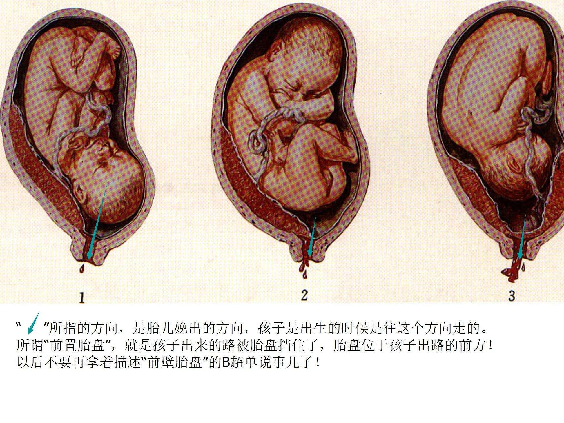 胎盘前壁后壁不一样，别乱猜测，早做到正确了解_胎儿